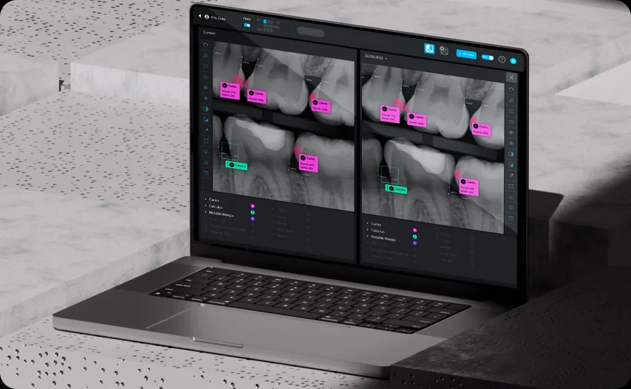 Pearl Dental AI diagnostic interface on a laptop